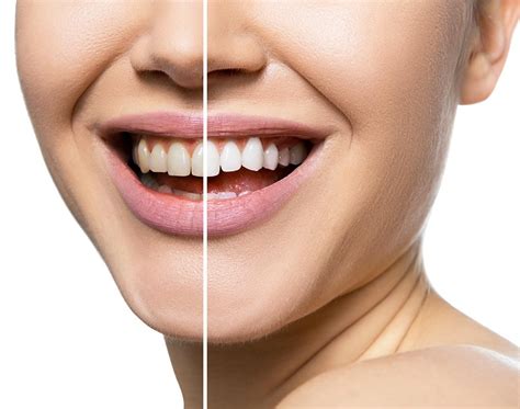 teeth whitening upper coomera <em> Implant-retained dentures</em>